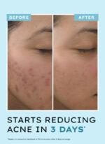 Anti Acne Face Serum with 10% Azelaic Acid & 2% Salicylic Acid - 30 ml - Image 5