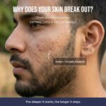 Acne Defense Mucin Serum - Image 4